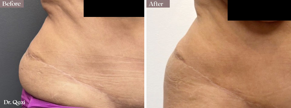 smartlipo flanks before after